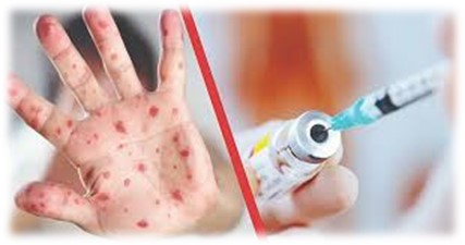 Корь - информация о заболевании Корь - информация о заболевании